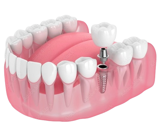 Festsitzender Zahnersatz auf Implantat – H & R Dentaltechnik GmbH